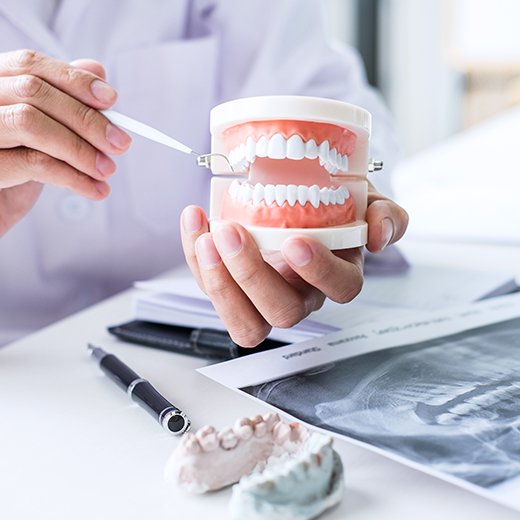 Model smile with dental implant supported dentures