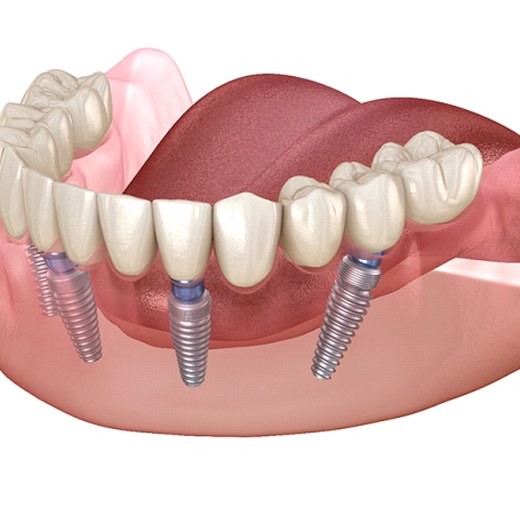 Diagram showing how implant dentures in Cleveland work