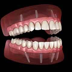 Illustration of All-on-4 Dentures