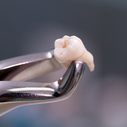 Metal clasp holding a tooth after a surgical extraction