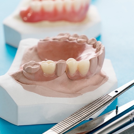 Model denture options used during denture consultations