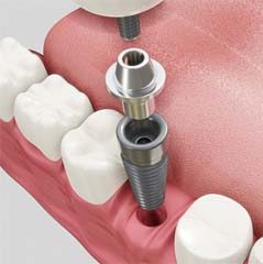 Diagram highlighting components of dental implants in Cleveland TX