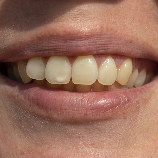 Yellow teeth before teeth whitening