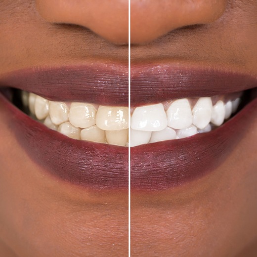 Closeup of patient's teeth before and after whitening treatment