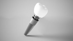 a computer illustration of a dental implant