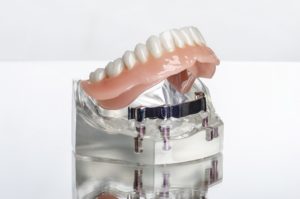 Model of implant denture