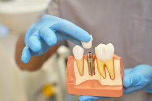 dentist placing crown on dental implant model
